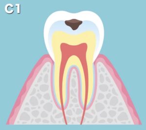 C1 ：エナメル質がむし歯
