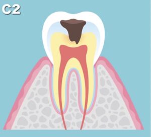 C２：象牙質が虫歯