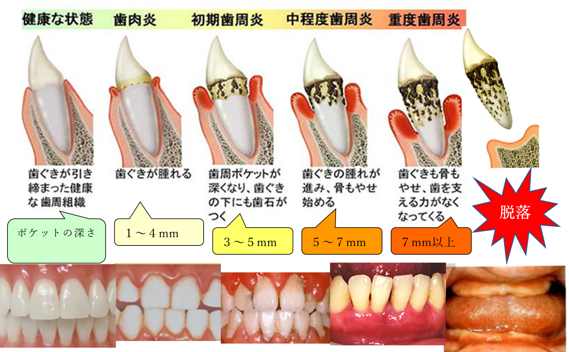歯 周 病 歯 が 抜ける 年齢