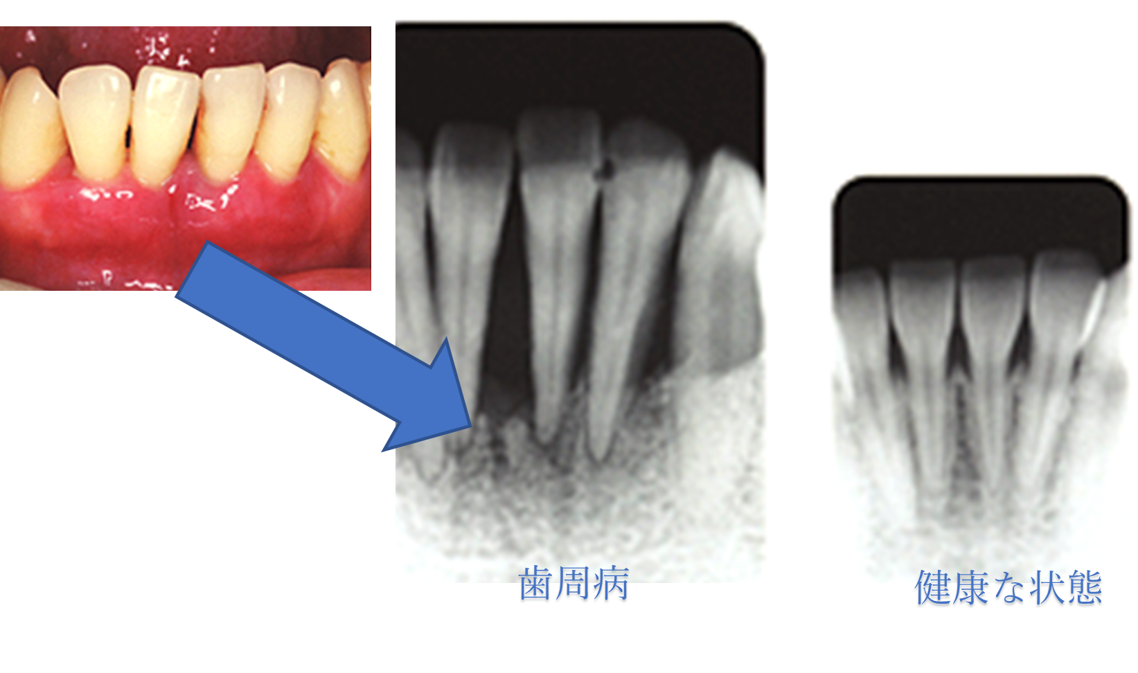 成人の8割が罹る歯周病とは？一緒に学んで歯を歯周病から守りま